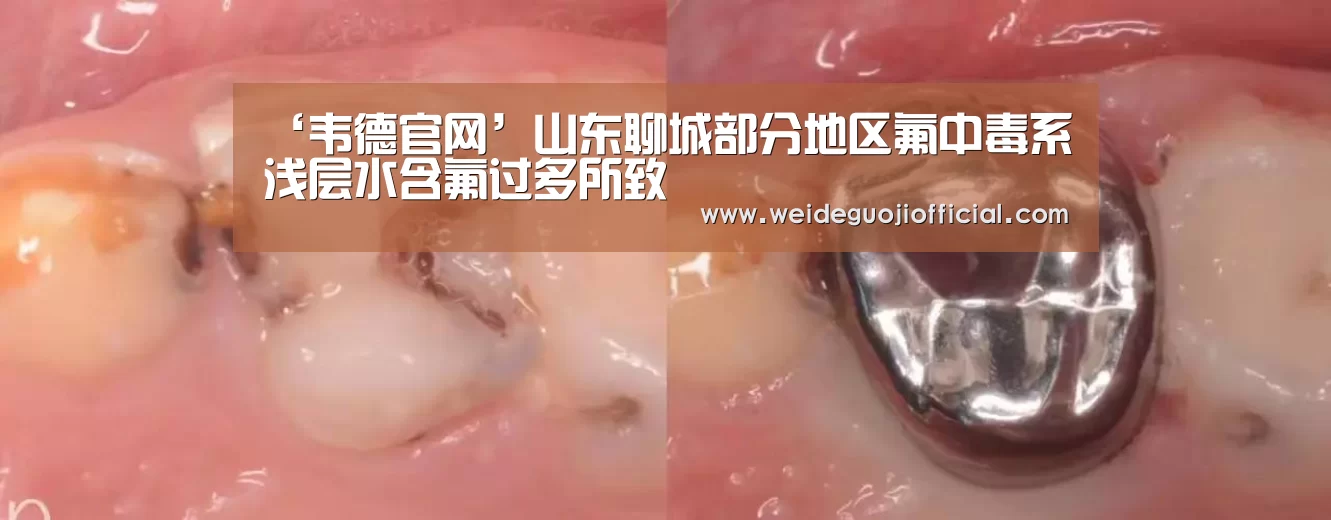 ‘韦德官网’山东聊城部分地区氟中毒系浅层水含氟过多所致(图2) 韦德体育